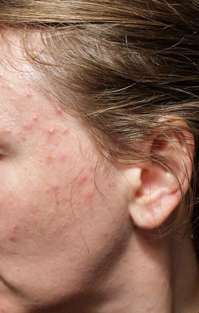 photo of my cheek with painful acne