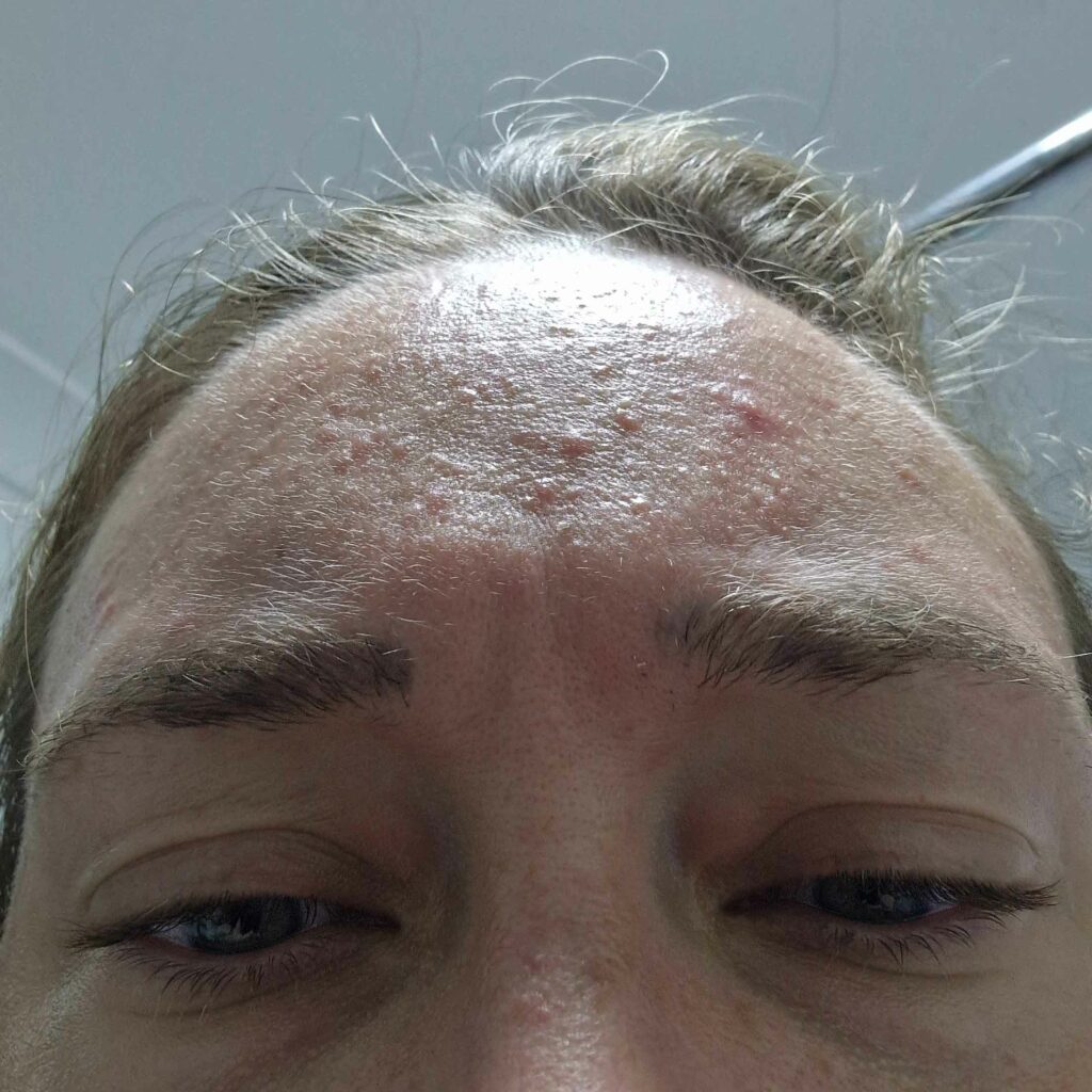 photo of my forehead with painful acne